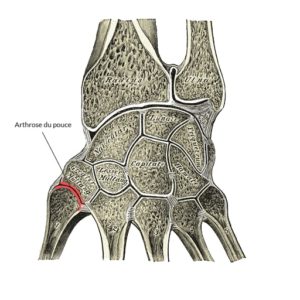 localisation arthrose du pouce